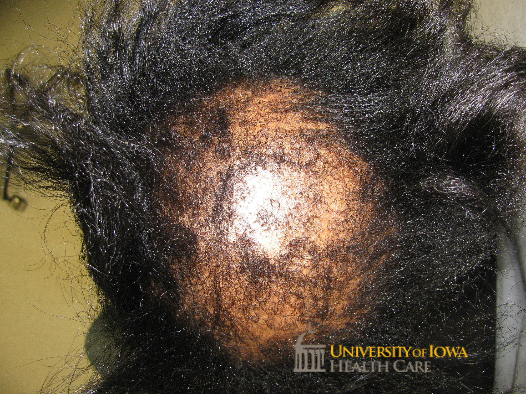 Circular patch of scarring alopecia with some retained hair follicles on the vertex scalp. (click images for higher resolution).